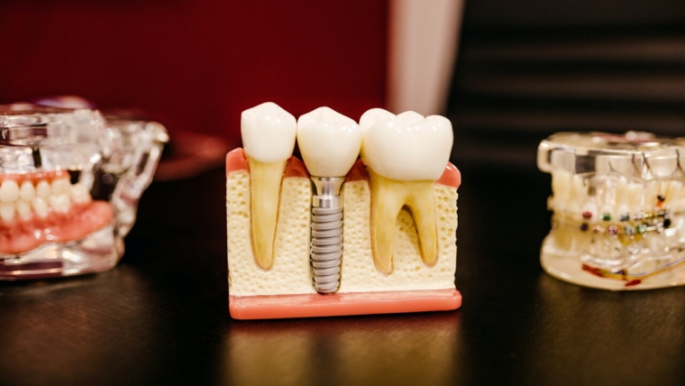Dental Implants vs. Dental Crowns and Bridges: The Best Option for Replacing a Damaged Tooth!