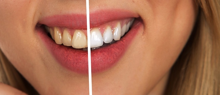 Concerned with the Colour of Your Teeth? Consider Professional Teeth Whitening!